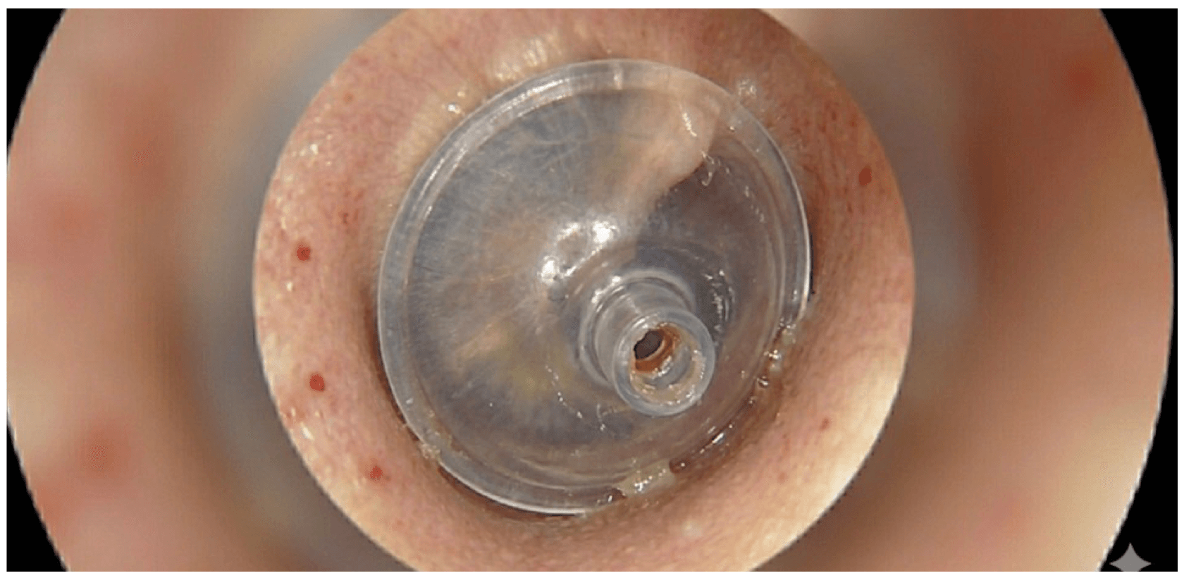 Otoscopic view of a foreign body seated in the external auditory canal